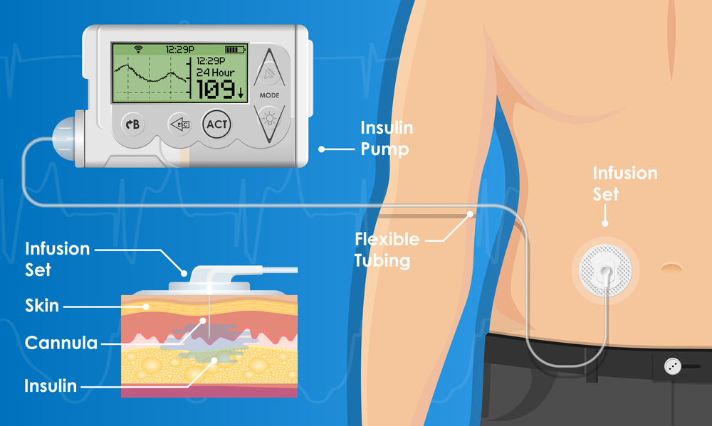 Insulin Pump Therapy in Navi Mumbai, Diabetes Pump Therapy