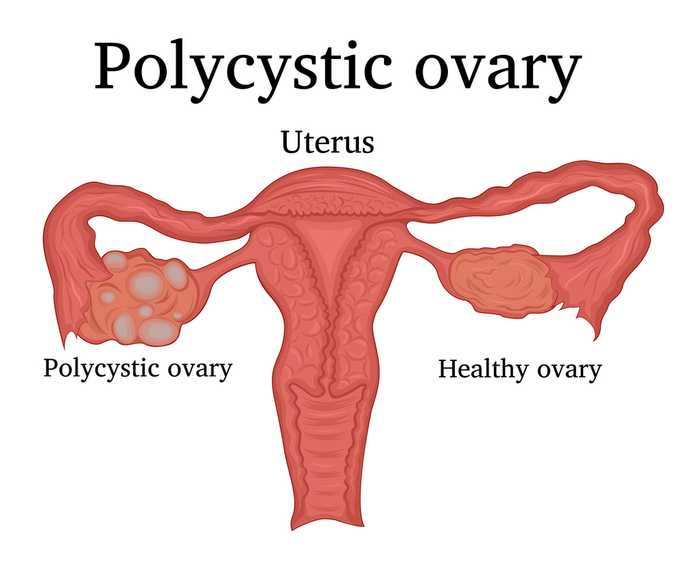 pcos and pcod treatment in nerul, kharghar, navi mumbai